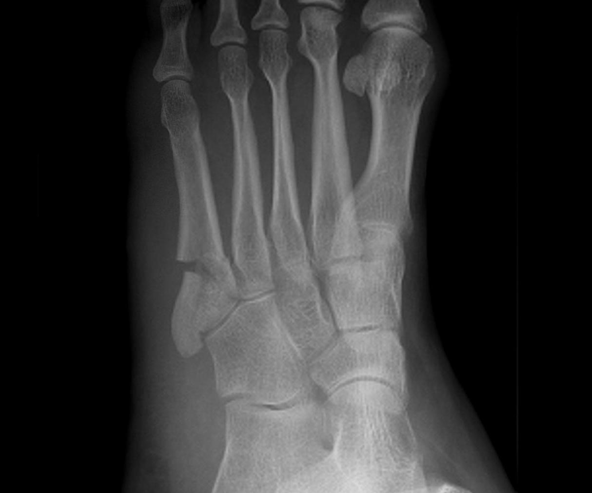 Jones Fracture 2